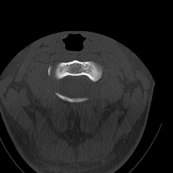 File:Occipital condyle fracture (Radiopaedia 31755-32691 Axial bone window 18).jpg