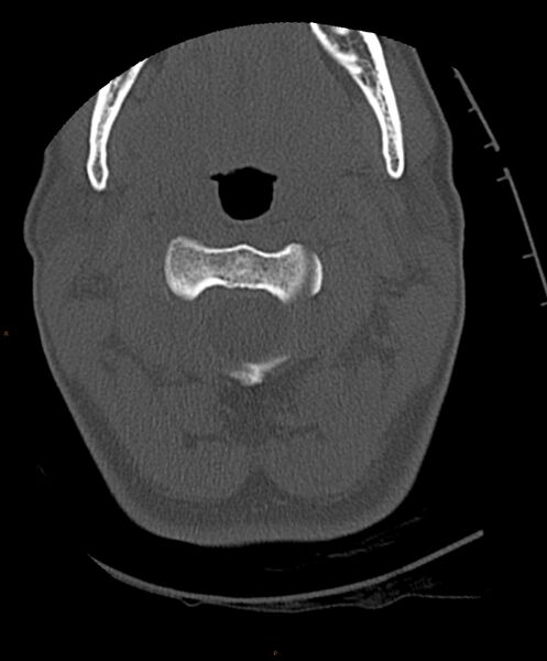 File:Occipital condyle fracture (Radiopaedia 61165-69056 D 11).jpg