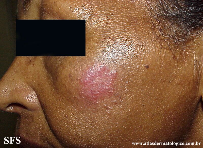 File:Sarcoidosis (Dermatology Atlas 34).jpg