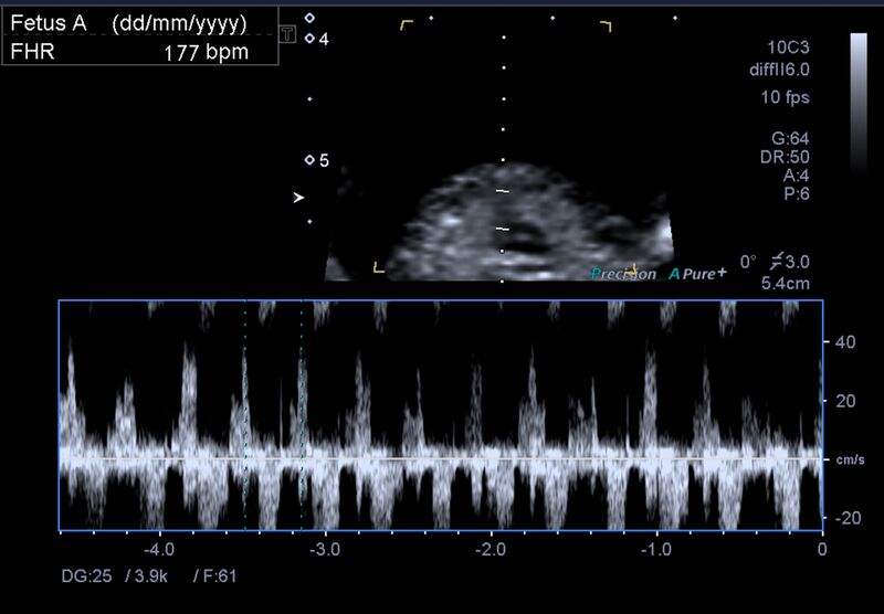 File:1st trimester nuchal-morphology ultrasound (Radiopaedia 44706-48477 General anatomy and NT 15).jpg