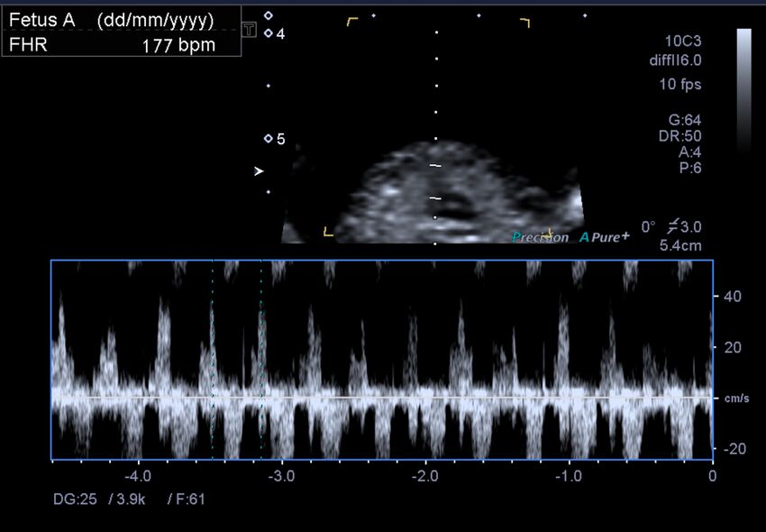 1st trimester nuchal-morphology ultrasound (Radiopaedia 44706-48477 General anatomy and NT 15).jpg