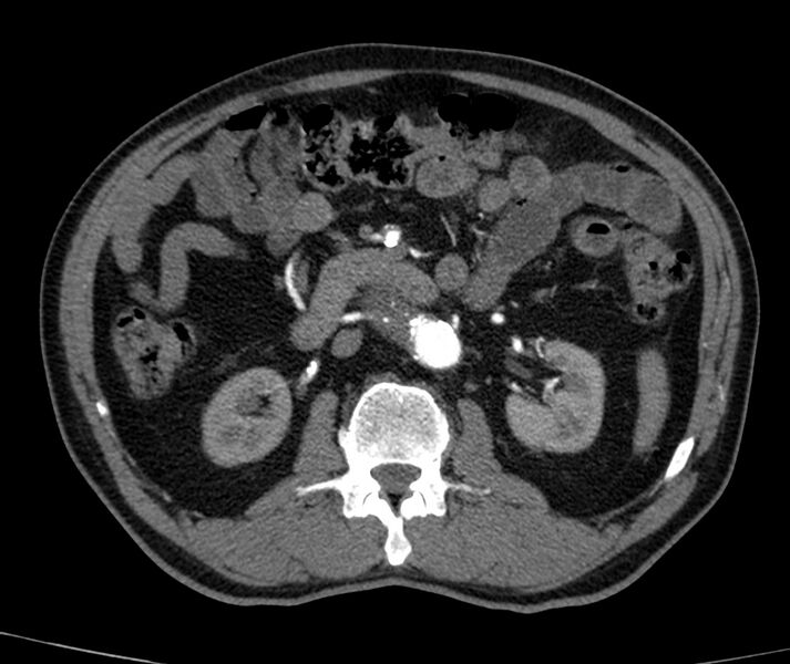 File:Abdominal aortic aneurysm (Radiopaedia 22421-22458 C+ arterial phase 35).jpg
