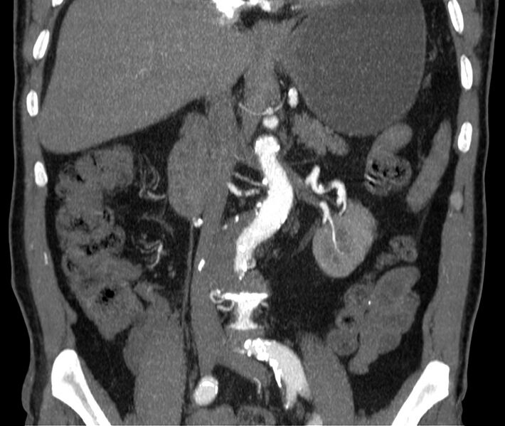 File:Abdominal aortic aneurysm (Radiopaedia 22421-22458 C 21).jpg