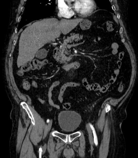 File:Abdominal aortic aneurysm (Radiopaedia 25855-26001 Coronal C+ arterial phase 18).jpg