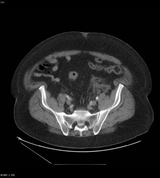 File:Abdominal aortic aneurysm with intramural hematoma then rupture (Radiopaedia 50278-55631 Axial C+ arterial phase 102).jpg