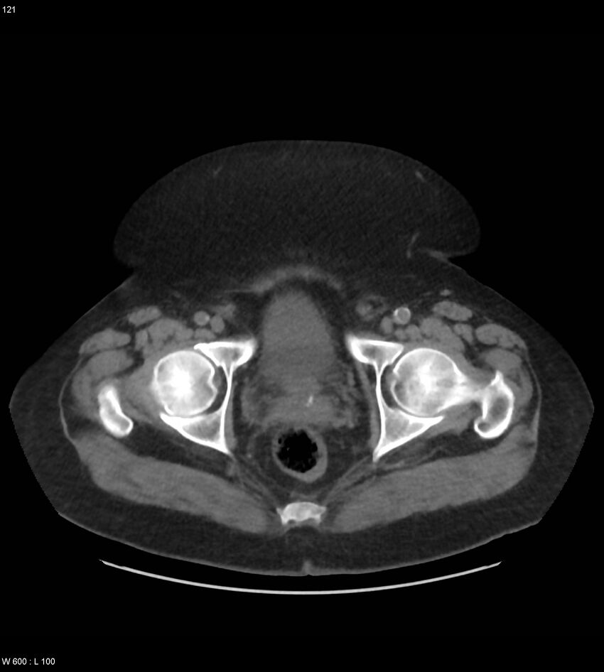 Abdominal aortic aneurysm with intramural hematoma then rupture (Radiopaedia 50278-55631 Axial non-contrast 117).jpg