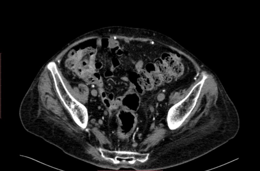 Abdominal aortic interposition tube graft and aneurysm thrombosis (Radiopaedia 71438-81857 Axial C+ arterial phase 189).jpg