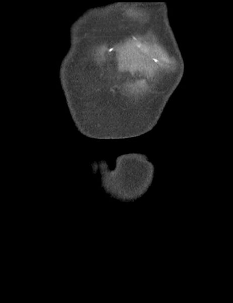 File:Abdominal wall metastasis from colorectal carcinoma (Radiopaedia 31016-31717 Coronal C+ portal venous phase 2).jpg