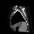 Aberrant left pulmonary artery (pulmonary sling) (Radiopaedia 42323-45435 Sagittal C+ arterial phase 48).jpg