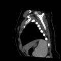 Aberrant left pulmonary artery (pulmonary sling) (Radiopaedia 42323-45435 Sagittal C+ arterial phase 49).jpg