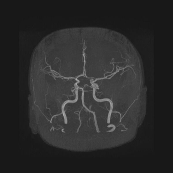 File:Accessory middle cerebral artery and ICA aneurysm (Radiopaedia 22656-22674 B 6).jpg