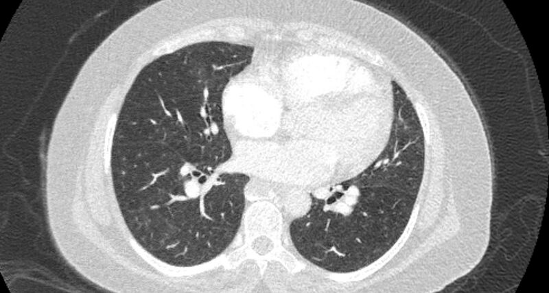 File:Accessory right inferior hepatic vein (Radiopaedia 65245-74259 Axial lung window 43).jpg