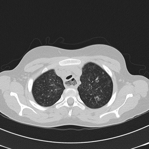 File:Achalasia (Radiopaedia 14946-14878 Axial lung window 11).jpg