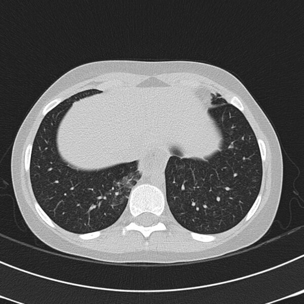 File:Achalasia (Radiopaedia 14946-14878 Axial lung window 65).jpg