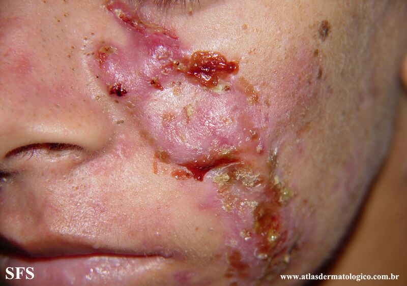 File:Acne Fulminans (Dermatology Atlas 7).jpg