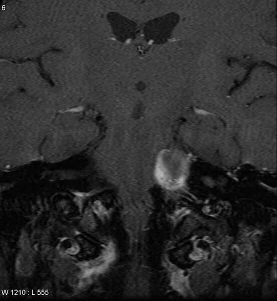 File:Acoustic schwannoma (large with cystic change) (Radiopaedia 5369-7130 Coronal T1 C+ fat sat 3).jpg