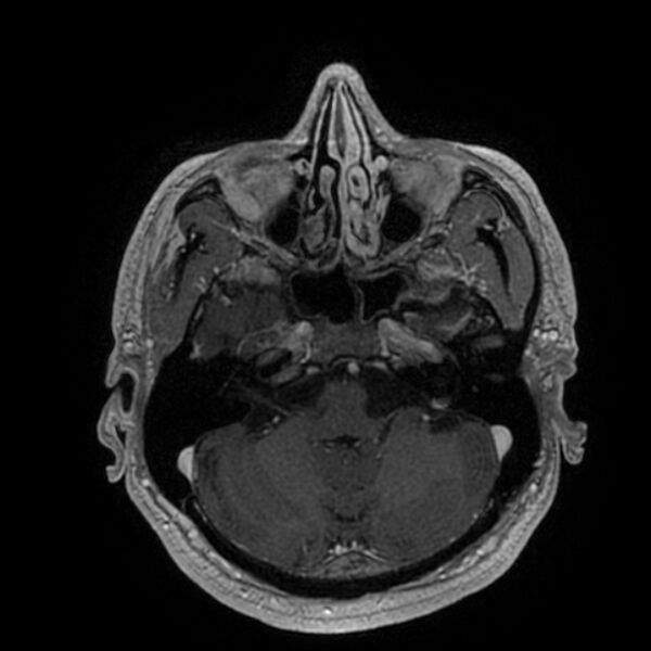 File:Acoustic schwannoma - intracanalicular (Radiopaedia 37247-39024 Axial T1 C+ 64).jpg