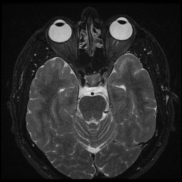 File:Acoustic schwannoma - intracanalicular (Radiopaedia 37247-39024 Axial T2 fat sat 13).jpg