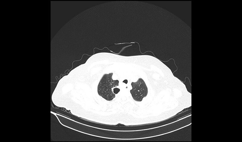 File:Acquired tracheo-esophageal fistula (Radiopaedia 51356-57103 Axial lung window 6).jpg
