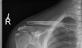 Acromioclavicular joint injury - Rockwood III (Radiopaedia 60196-67799 E 1).jpg