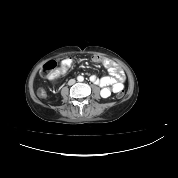File:Acute-on-chronic Crohn disease with enteroenteric fistula (Radiopaedia 66686-75987 B 11).jpg