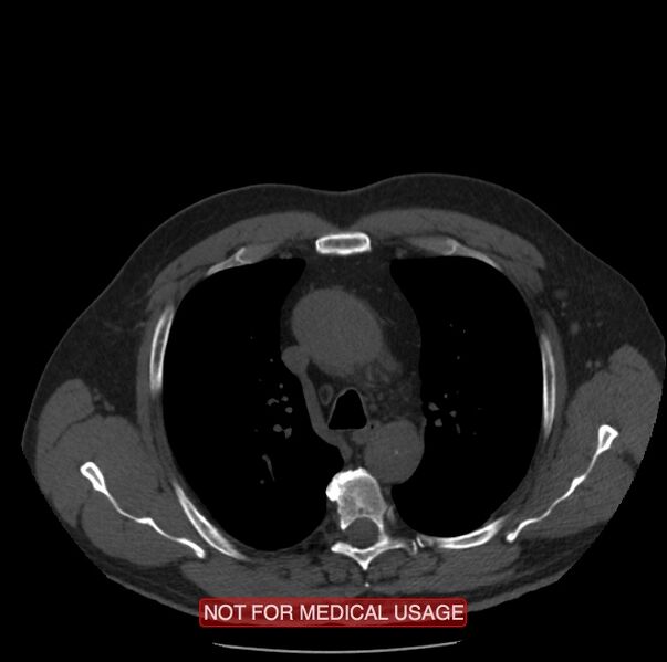File:Acute aortic dissection - Stanford type A (Radiopaedia 40661-43285 Axial non-contrast 11).jpg