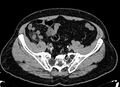 Acute appendicitis (Radiopaedia 13030-13091 Axial non-contrast 47).jpg