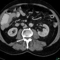 Acute appendicitis arising from a malrotated cecum (Radiopaedia 19970-19997 Axial C+ portal venous phase 14).jpg