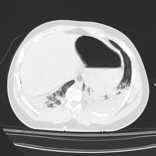 File:Acute aspiration pneumonitis (Radiopaedia 33605-34703 Axial lung window 82).jpg