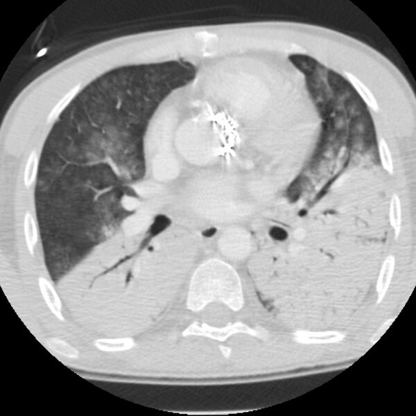 File:Acute diffuse alveolar hemorrhage (Radiopaedia 41323-44158 Axial lung window 31).jpg
