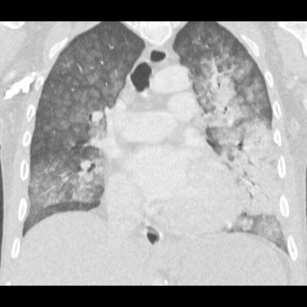 File:Acute diffuse alveolar hemorrhage (Radiopaedia 41323-44158 Coronal lung window 25).jpg