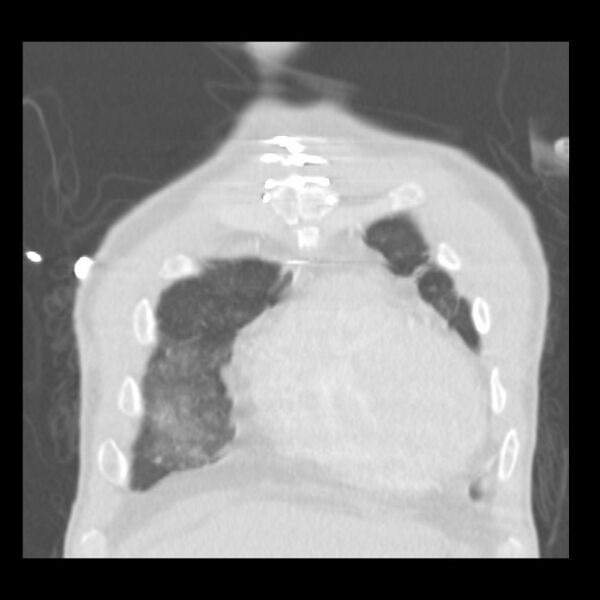 File:Acute diffuse alveolar hemorrhage (Radiopaedia 41323-44158 Coronal lung window 3).jpg