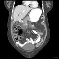 Acute pancreatitis (Radiopaedia 19136-19117 Coronal C+ portal venous phase 9).jpg