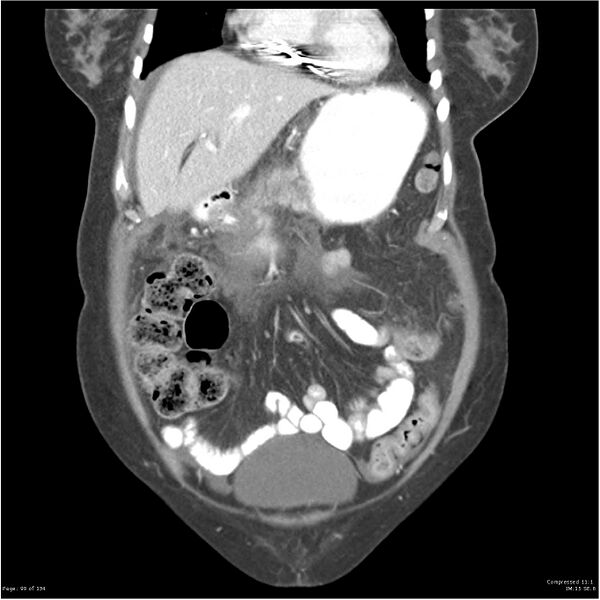 File:Acute pancreatitis (Radiopaedia 19136-19117 Coronal C+ portal venous phase 9).jpg