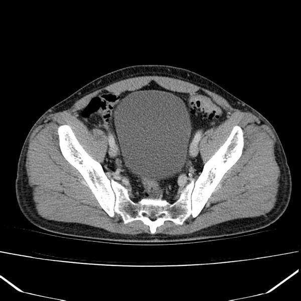 File:Acute pancreatitis (Radiopaedia 22572-22596 Axial C+ portal venous phase 60).jpg