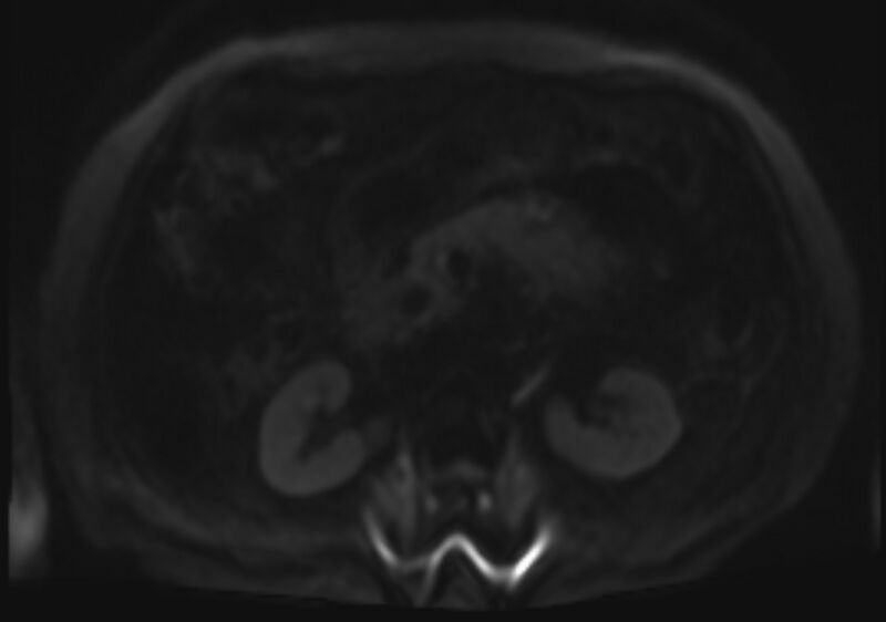 File:Acute portal vein thrombosis (Radiopaedia 73198-83925 Axial DWI 79).jpg