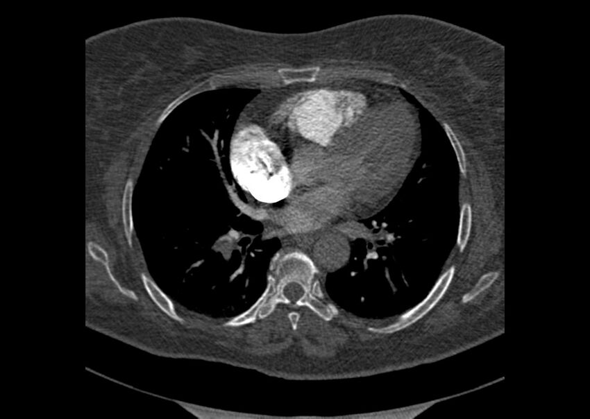Acute pulmonary embolism (Radiopaedia 29938-30466 Axial C+ CTPA 114).jpg