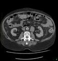 Acute renal failure post IV contrast injection- CT findings (Radiopaedia 47815-52559 Axial C+ portal venous phase 39).jpg