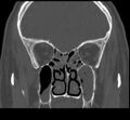 Acute sinusitis (Radiopaedia 23161-23215 Coronal bone window 39).jpg