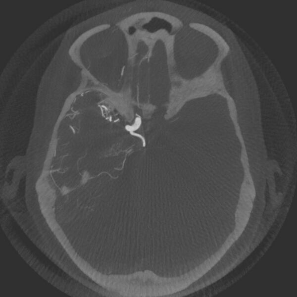 File:Acute subarachnoid hemorrhage and accessory anterior cerebral artery (Radiopaedia 69231-79010 Axial arterial - MIP 27).jpg