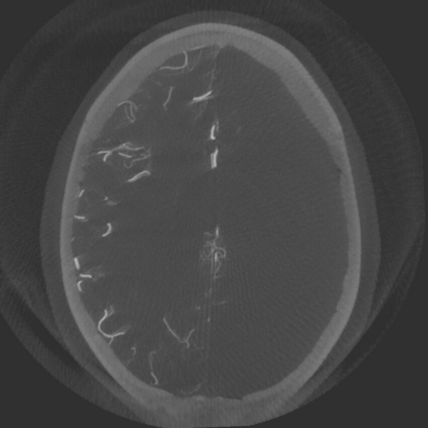 Acute subarachnoid hemorrhage and accessory anterior cerebral artery (Radiopaedia 69231-79010 Axial arterial - MIP 57).jpg