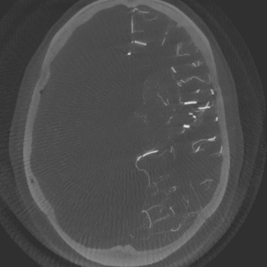 Acute subarachnoid hemorrhage and accessory anterior cerebral artery (Radiopaedia 69231-79010 C 34).jpg