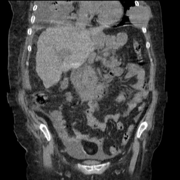 File:Acute tubular necrosis (Radiopaedia 28077-28334 D 39).jpg