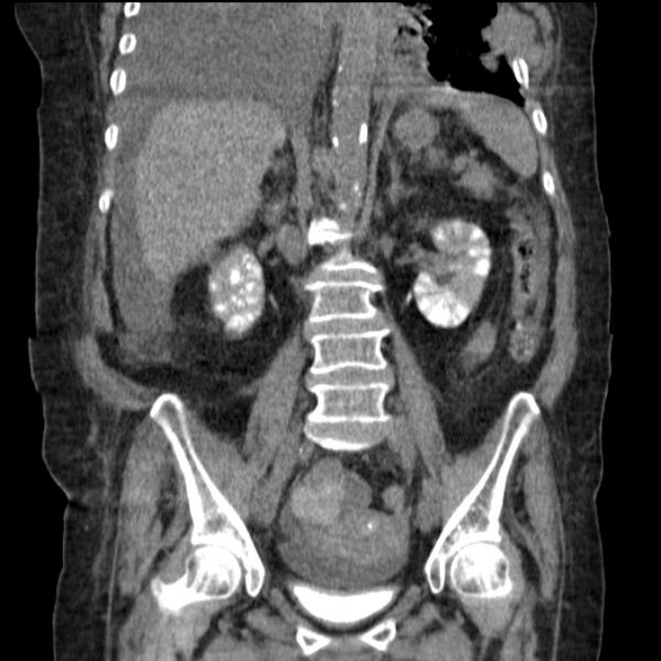 File:Acute tubular necrosis (Radiopaedia 28077-28334 D 51).jpg