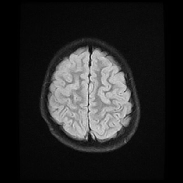 File:Adamantinomatous craniopharyngioma (Radiopaedia 77407-89529 Axial FLAIR 21).jpg