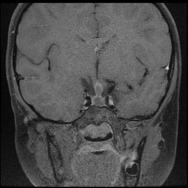 File:Adamantinomatous craniopharyngioma (Radiopaedia 77407-89529 Coronal T1 C+ fat sat 6).jpg