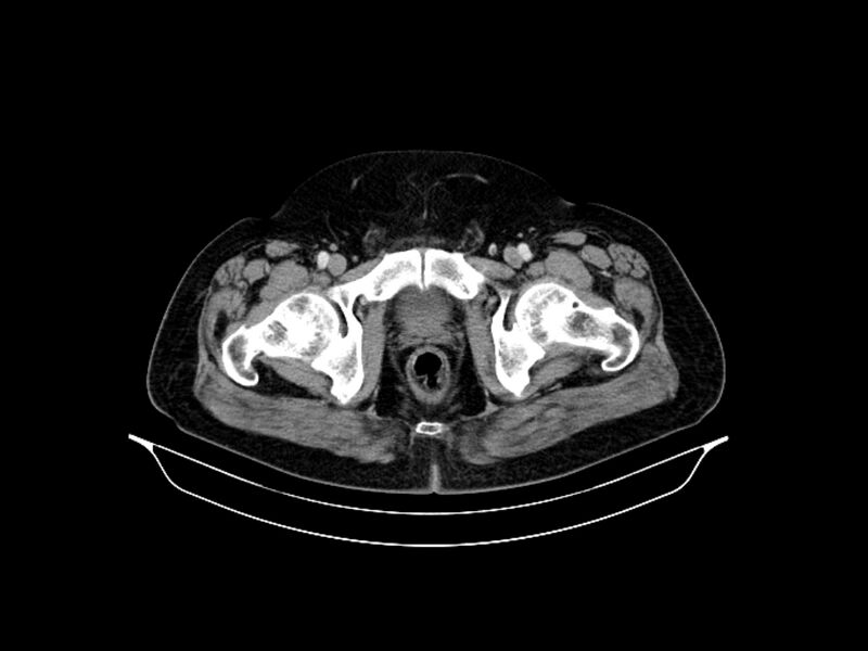 File:Adenocarcinoma of pancreas with hepatic metastasis (Radiopaedia 64332-73122 Axial C+ portal venous phase 99).jpg
