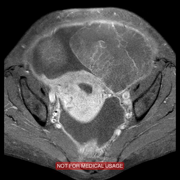 File:Adenocarcinoma of the cervix (Radiopaedia 28373-28615 Axial T1 C+ fat sat 14).jpg