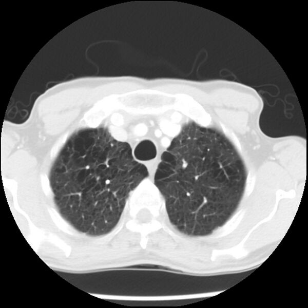 File:Adenocarcinoma of the lung - micropapillary predominant (Radiopaedia 42446-45563 Axial lung window 14).jpg