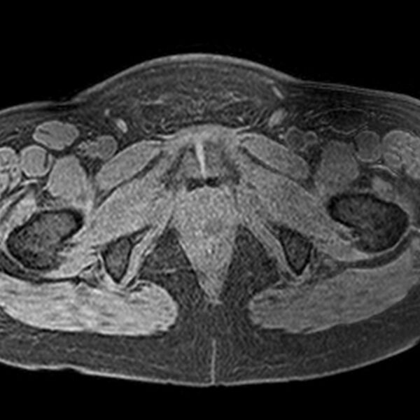 File:Adenomyoma of the uterus (Radiopaedia 9871-10439 Axial T1 fat sat 4).jpg